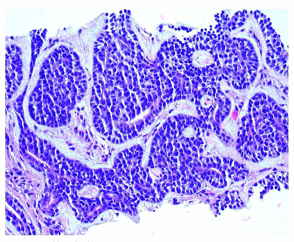 Cureus | Huffing and Puffing: A Rare Case of Tracheal Adenoid Cystic ...
