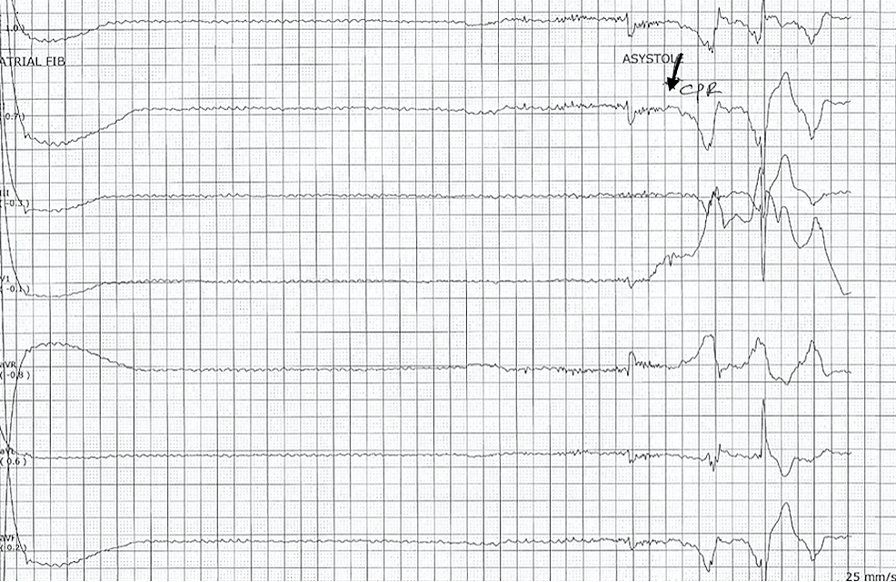 Cureus Cardiac Arrest Following Treatment With Diltiazem for Atrial