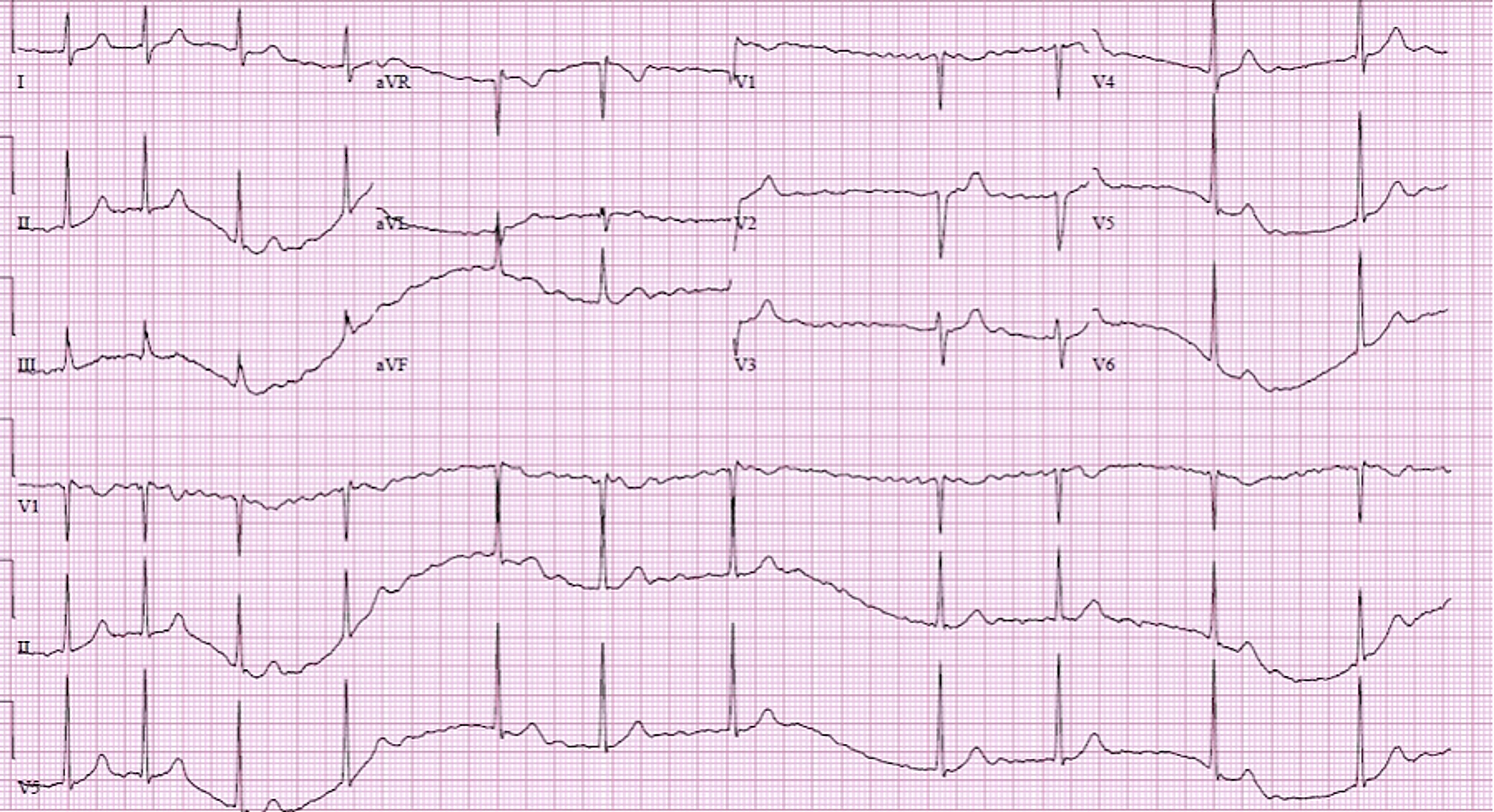 Cureus | Cardiac Arrest Following Treatment With Diltiazem for Atrial ...