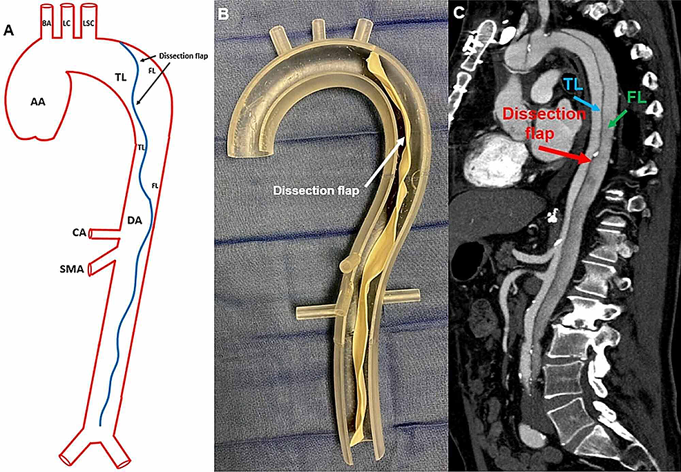 Cureus | Covered Or Not, Here I Come: Stanford Type B Aortic Dissection ...