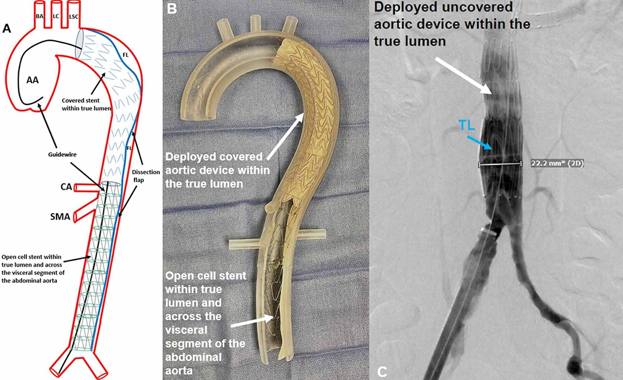 Aortic Dissection Stent