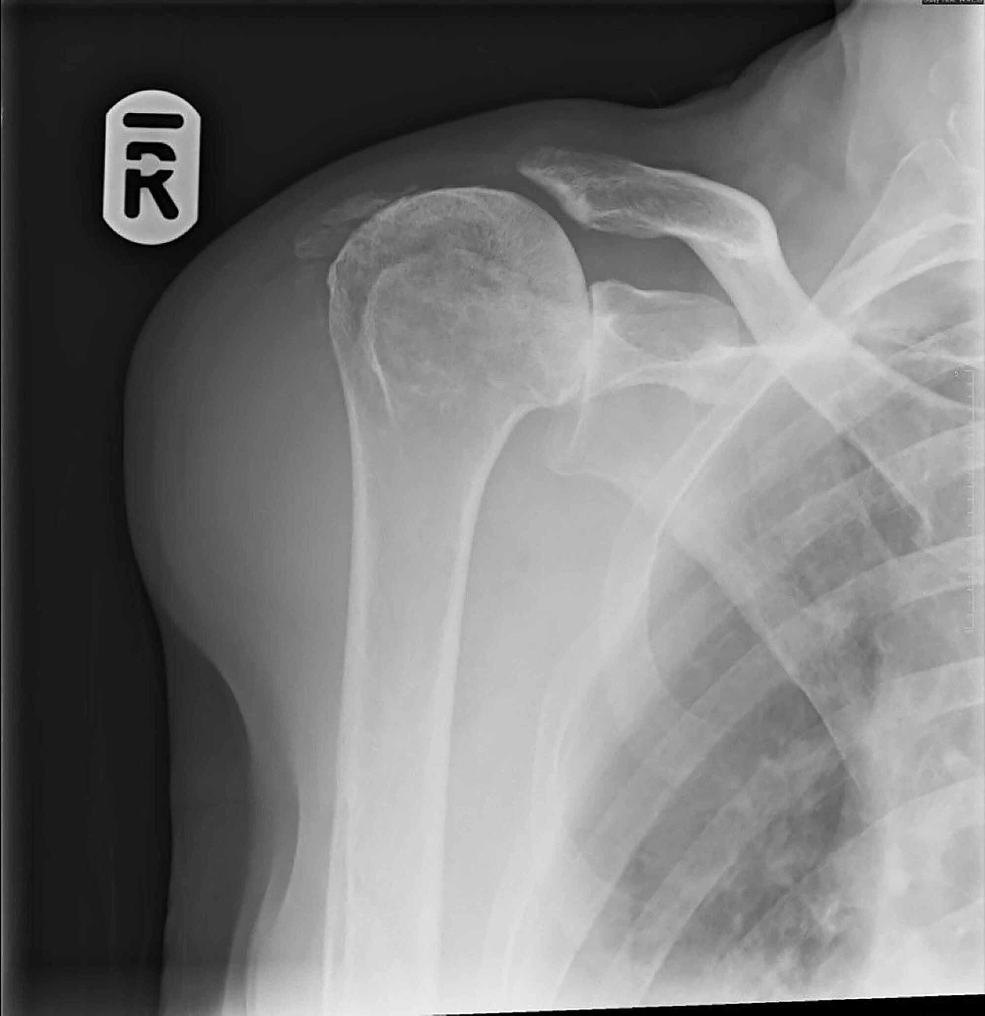Cureus Atraumatic Scapular Spine Fracture A Rare Injury in a Patient