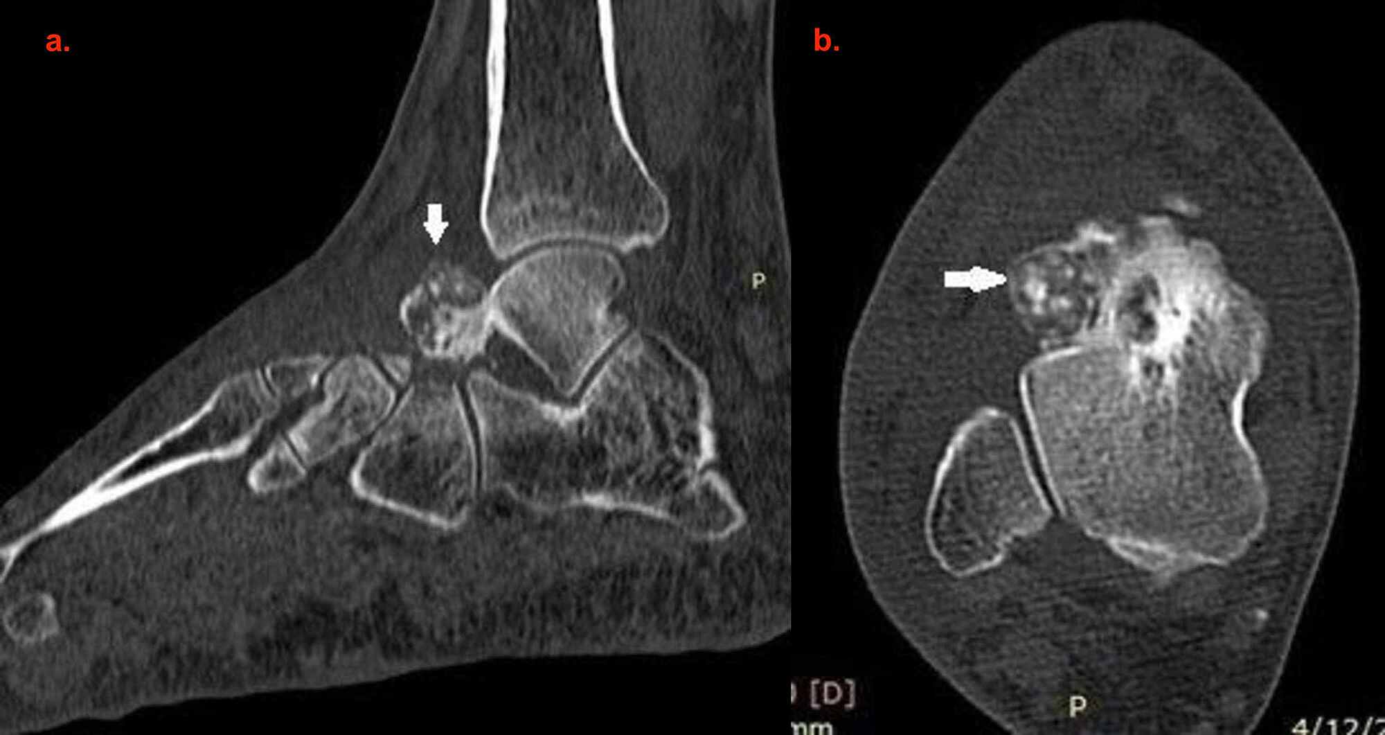 Cureus | Osteoblastoma Of Talus: A Diagnostic Dilemma