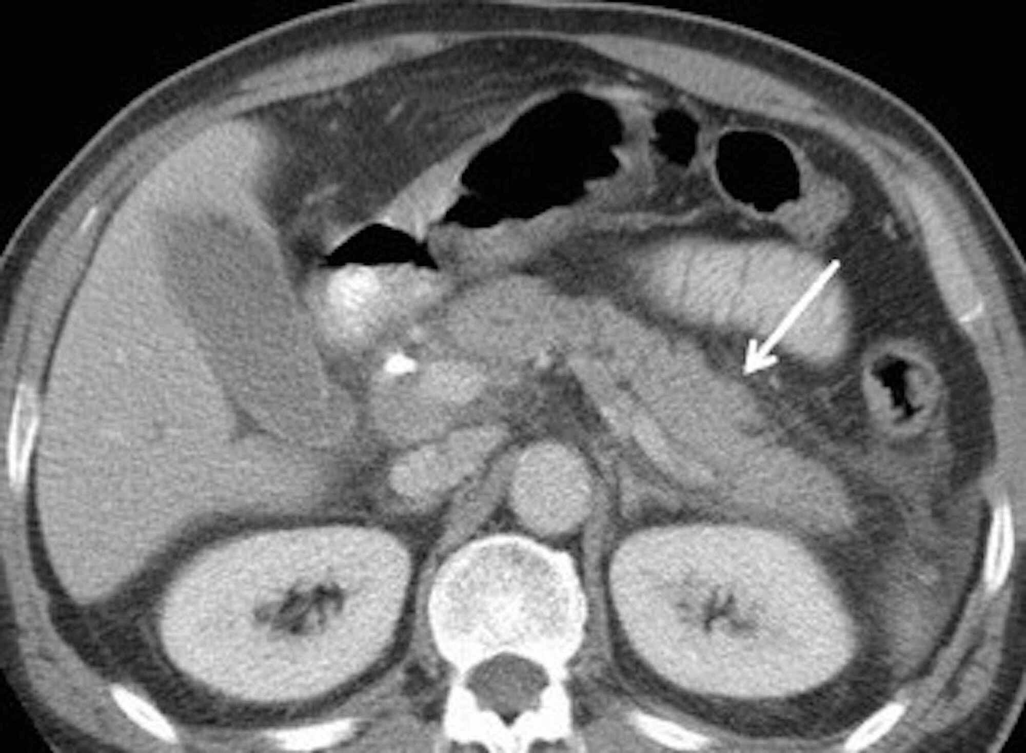 Cureus A Case of Severe Acute Pancreatitis Secondary to COVID19