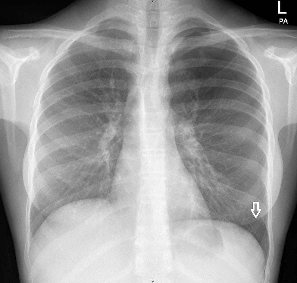 Chest-X-ray-showing-left-spontaneous-pneumothorax.