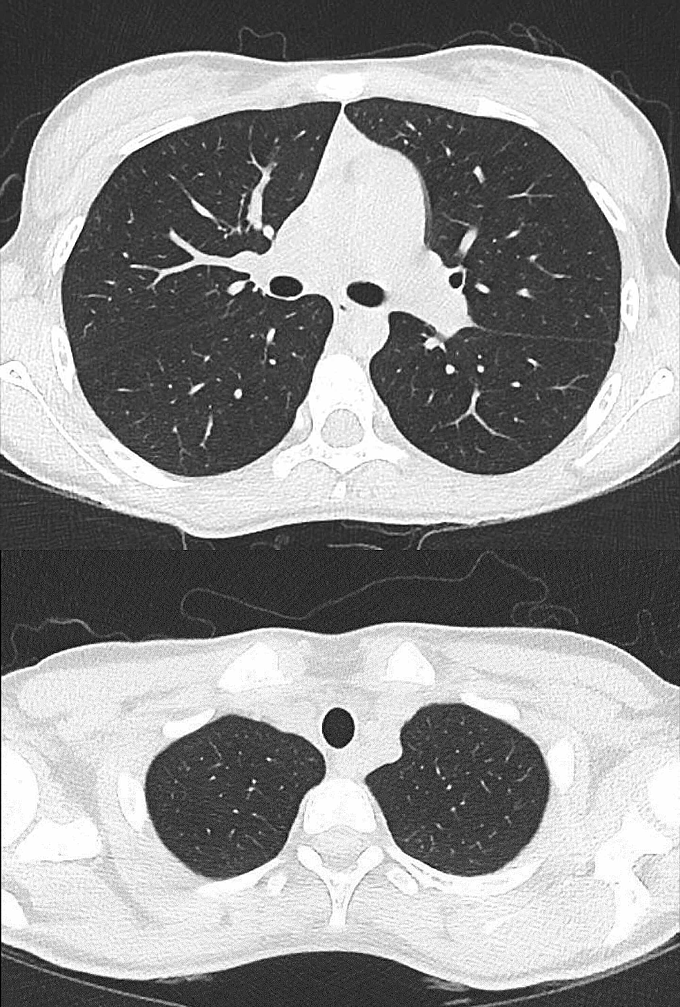 CT-Thorax-showing-resolution-of-the-pneumothorax-and-no-evidence-of-blebs-or-bullae
