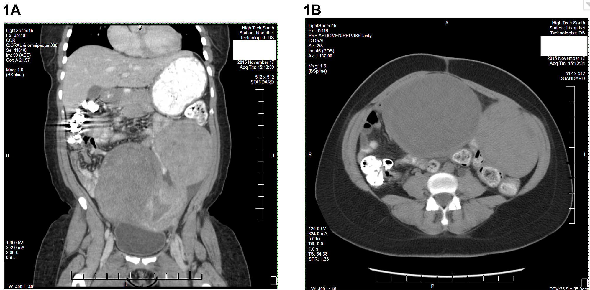 Cureus Massive Leiomyomata and Severe Endometriosis Resulting in a