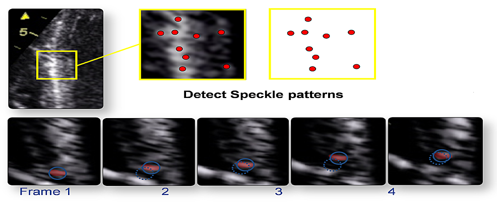 Speckle Tracking Echocardiography: Early Predictor of Diagnosis