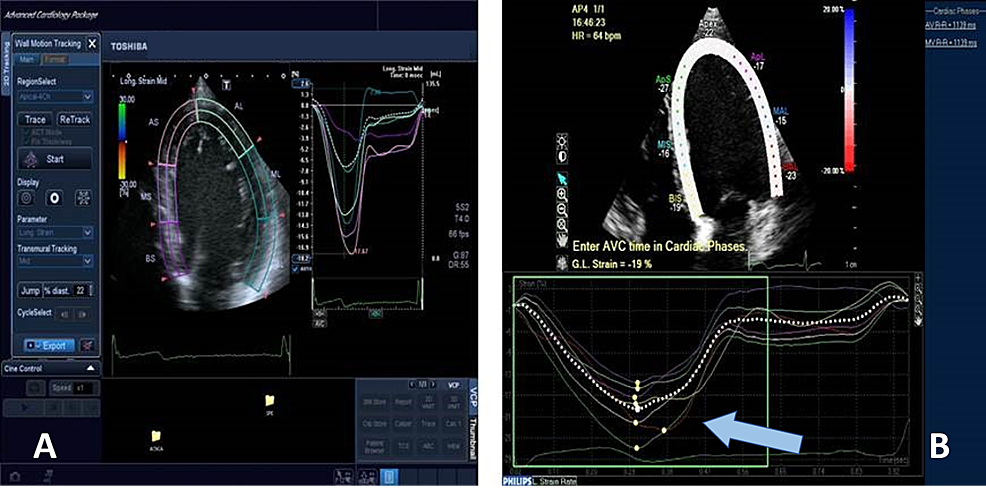 Cureus Role Of Speckle Tracking Echocardiography In Dilated 