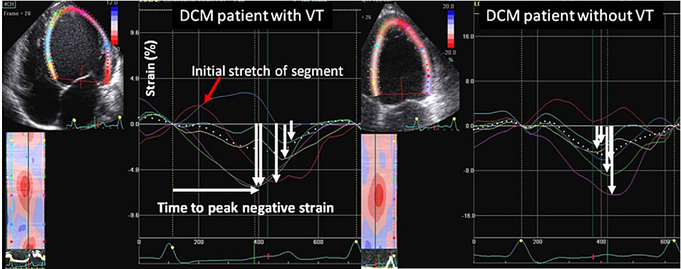 Cureus Role Of Speckle Tracking Echocardiography In Dilated 