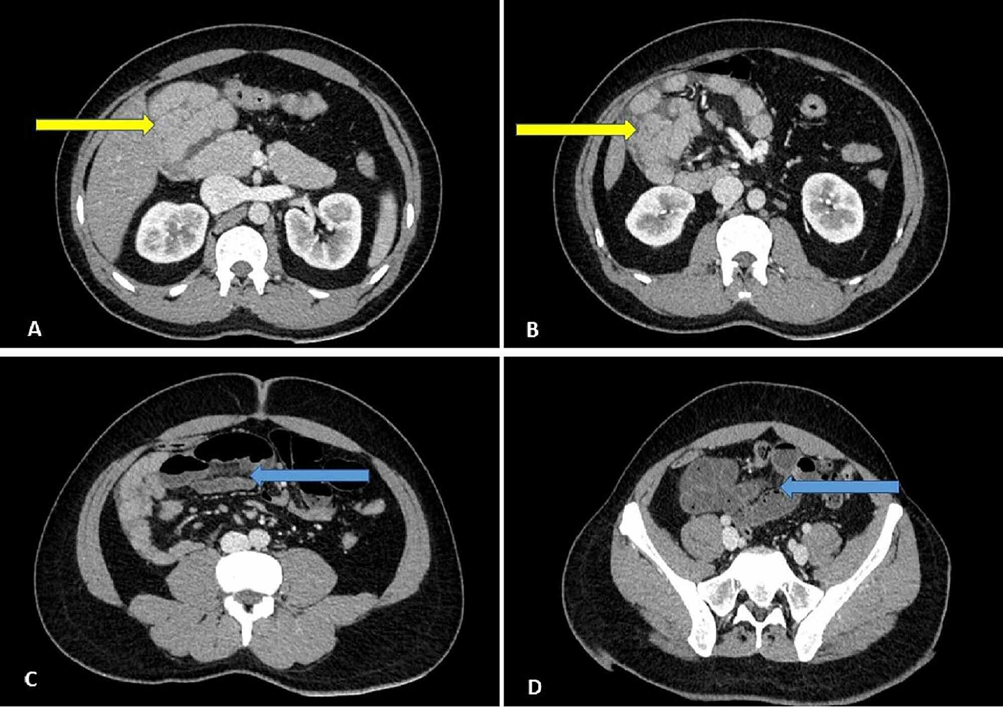 Cureus Right Paraduodenal Hernia A Rare Cause Of Small Bowel Strangulation 3370