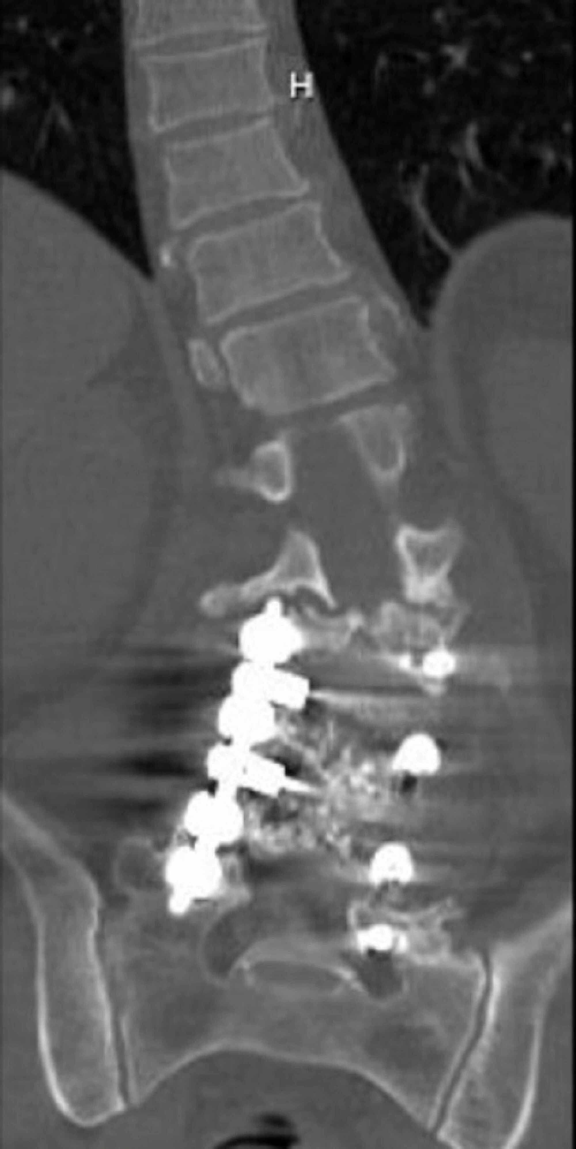 Cureus The “Kickstand Rod” Technique for Coronal Imbalance in