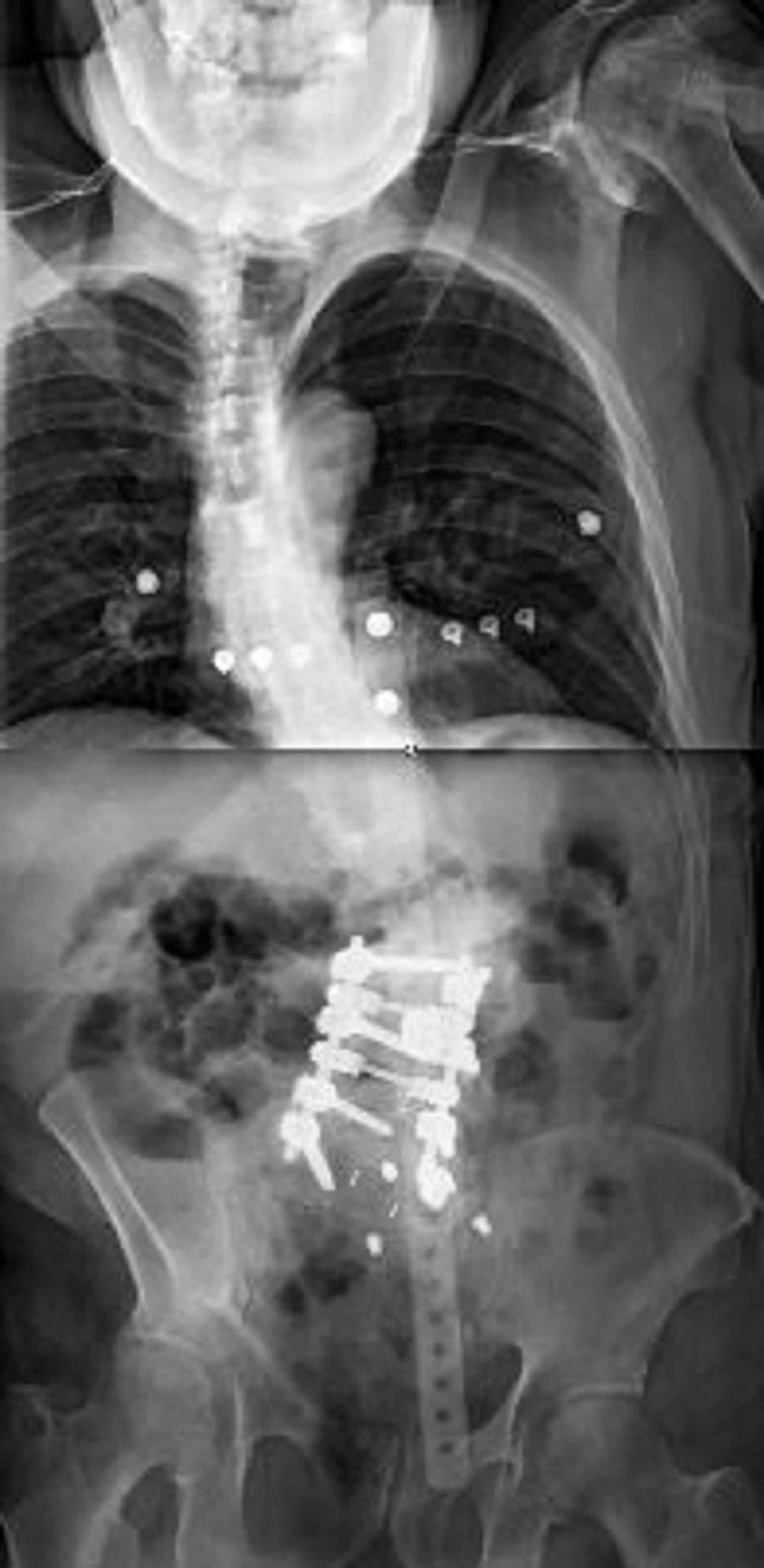 Cureus The “Kickstand Rod” Technique for Coronal Imbalance in