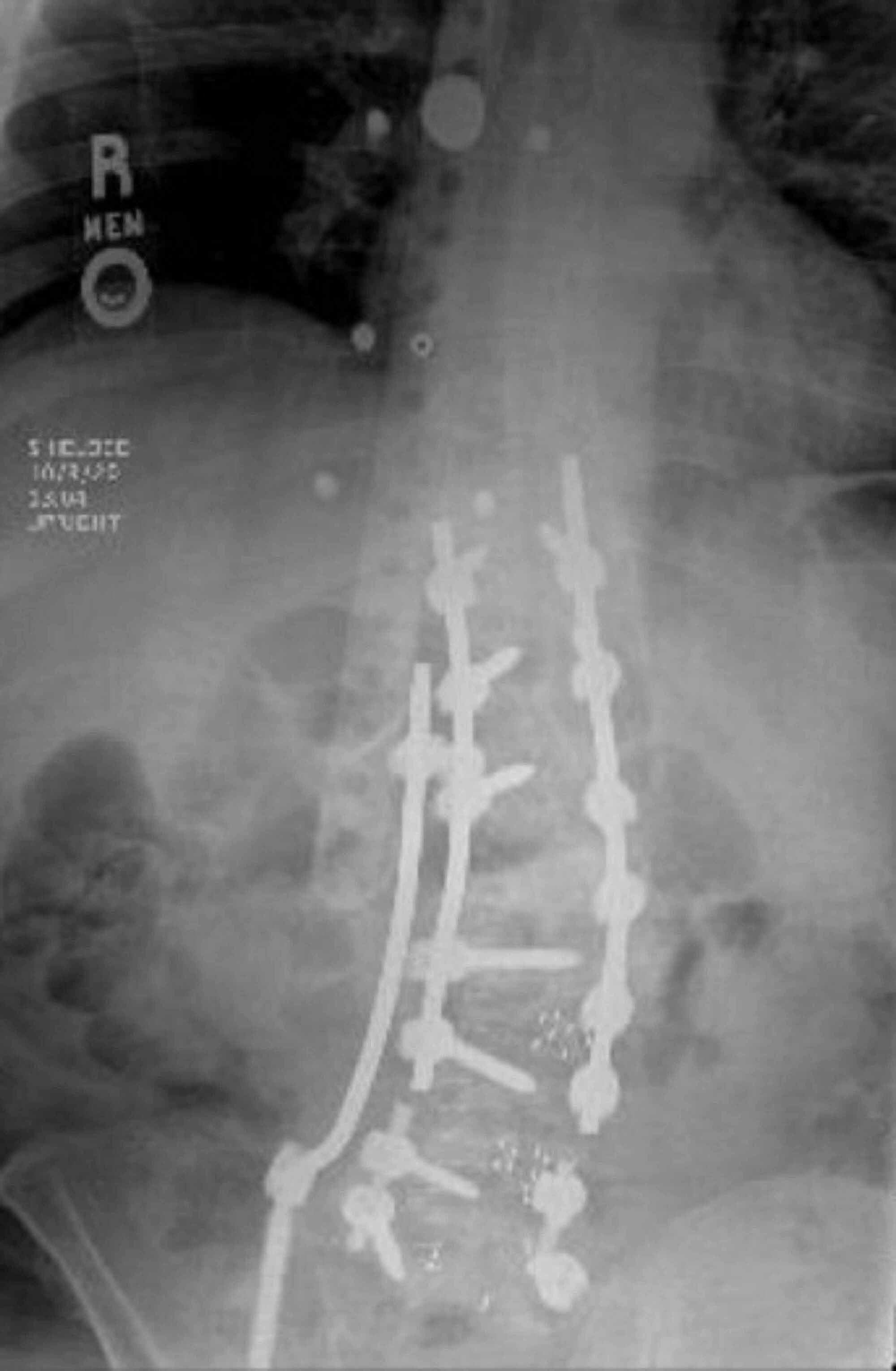 Cureus The “Kickstand Rod” Technique for Coronal Imbalance in