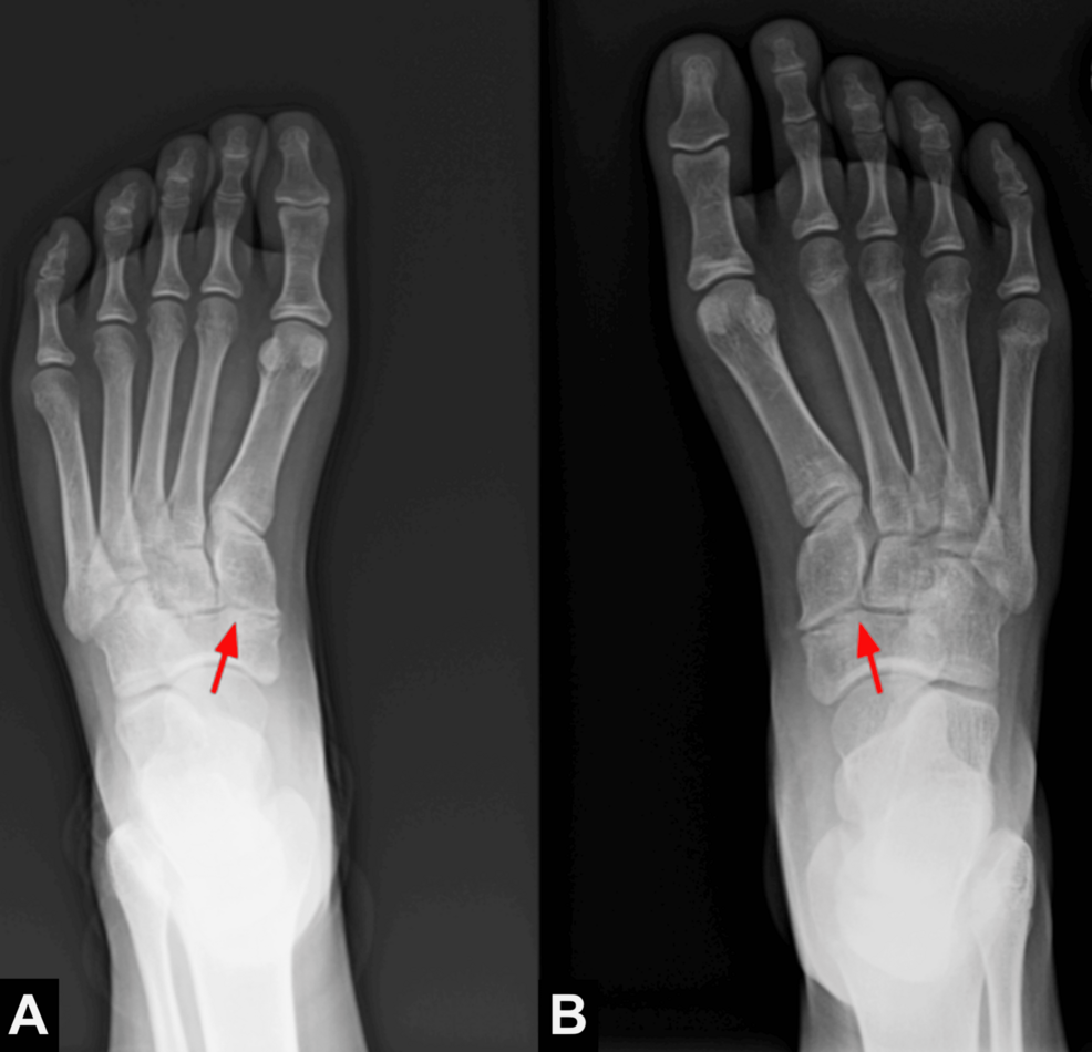Bilateral Naviculocuneiform Coalition in a Pediatric Patient: A Common  Pathology in a Rare Location | Cureus, image size:986x950
