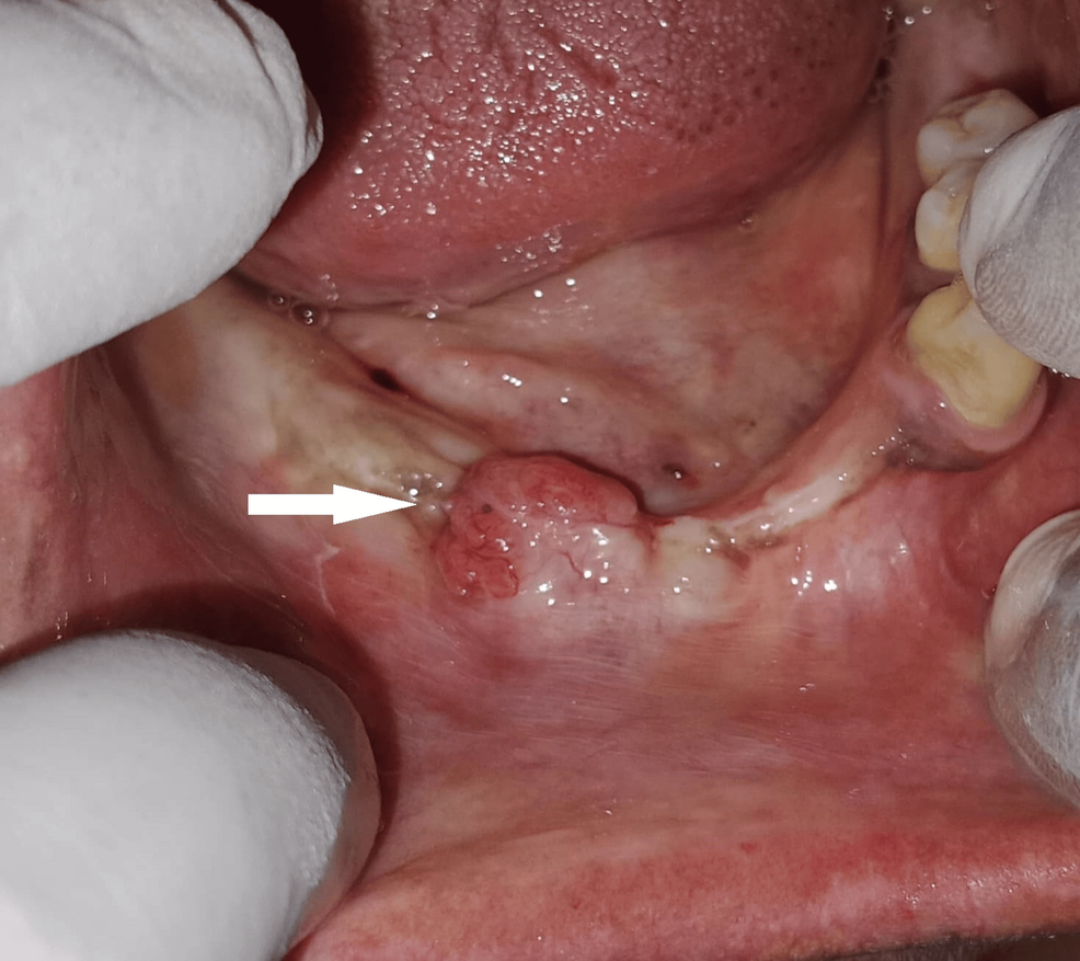 Vista preoperatoria que muestra una hinchazón firme y sésil en la cresta edéntula mandibular derecha.