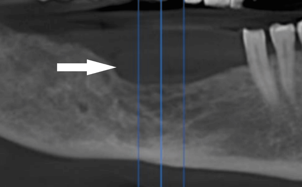 Reconstrucción panorámica a partir de CBCT que muestra una cresta intacta y un defecto quirúrgico en el sitio de enucleación anterior.