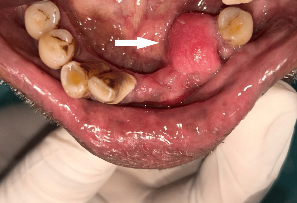 Imagen clínica preoperatoria que muestra una hinchazón firme y sésil en la encía lingual de la región premolar canina inferior izquierda, con mucosa intacta y lisa.