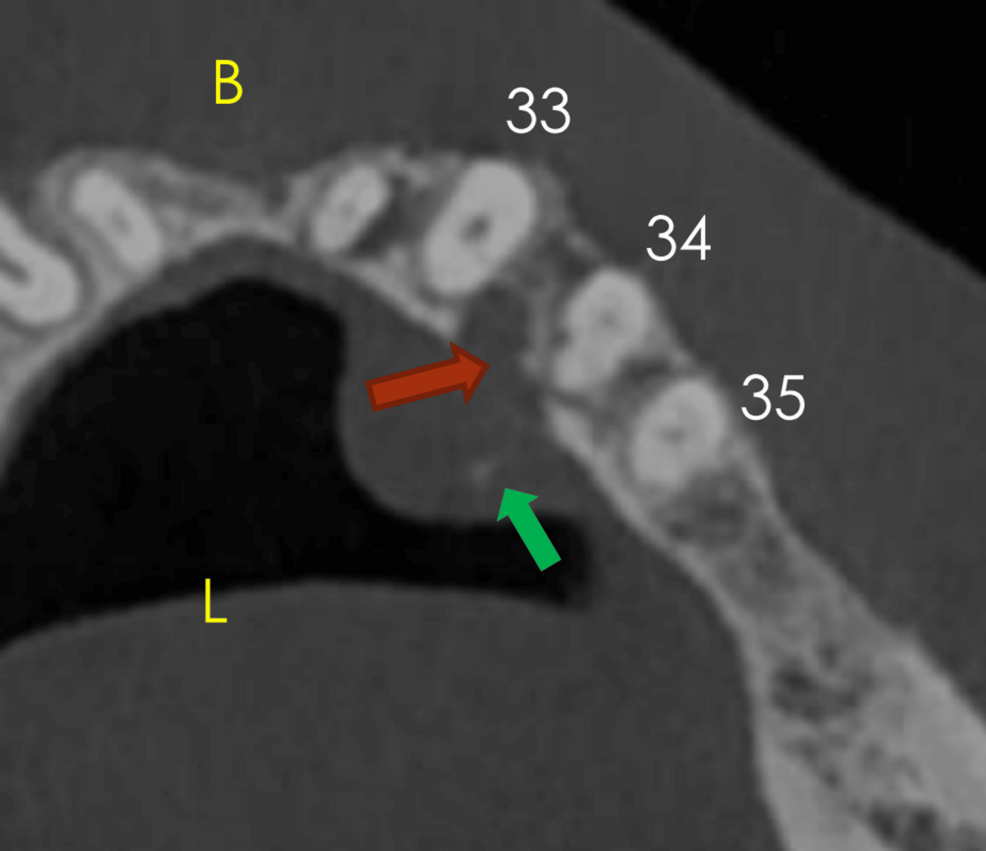 Imagen axial CBCT que muestra manchas hiperdensas internas dentro de la lesión de tejido blando (flecha verde) y erosión de la placa cortical lingual (flecha roja).