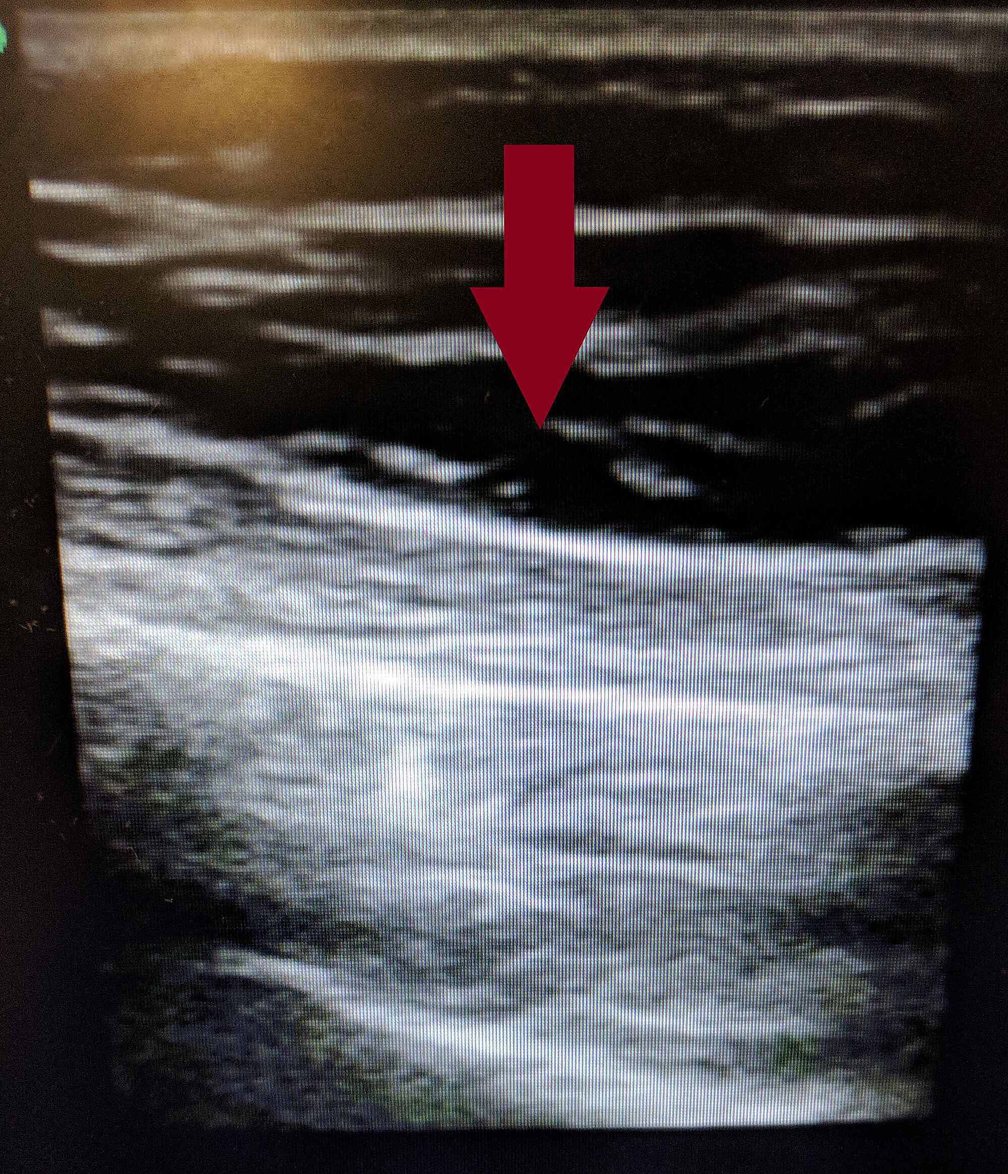 Necrotizing Fasciitis Ultrasound