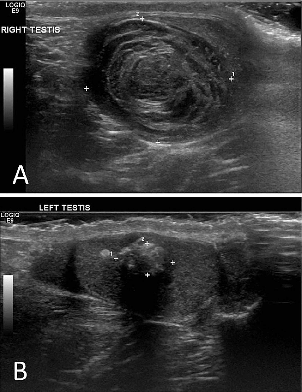 Scrotal Cysts Ultrasound