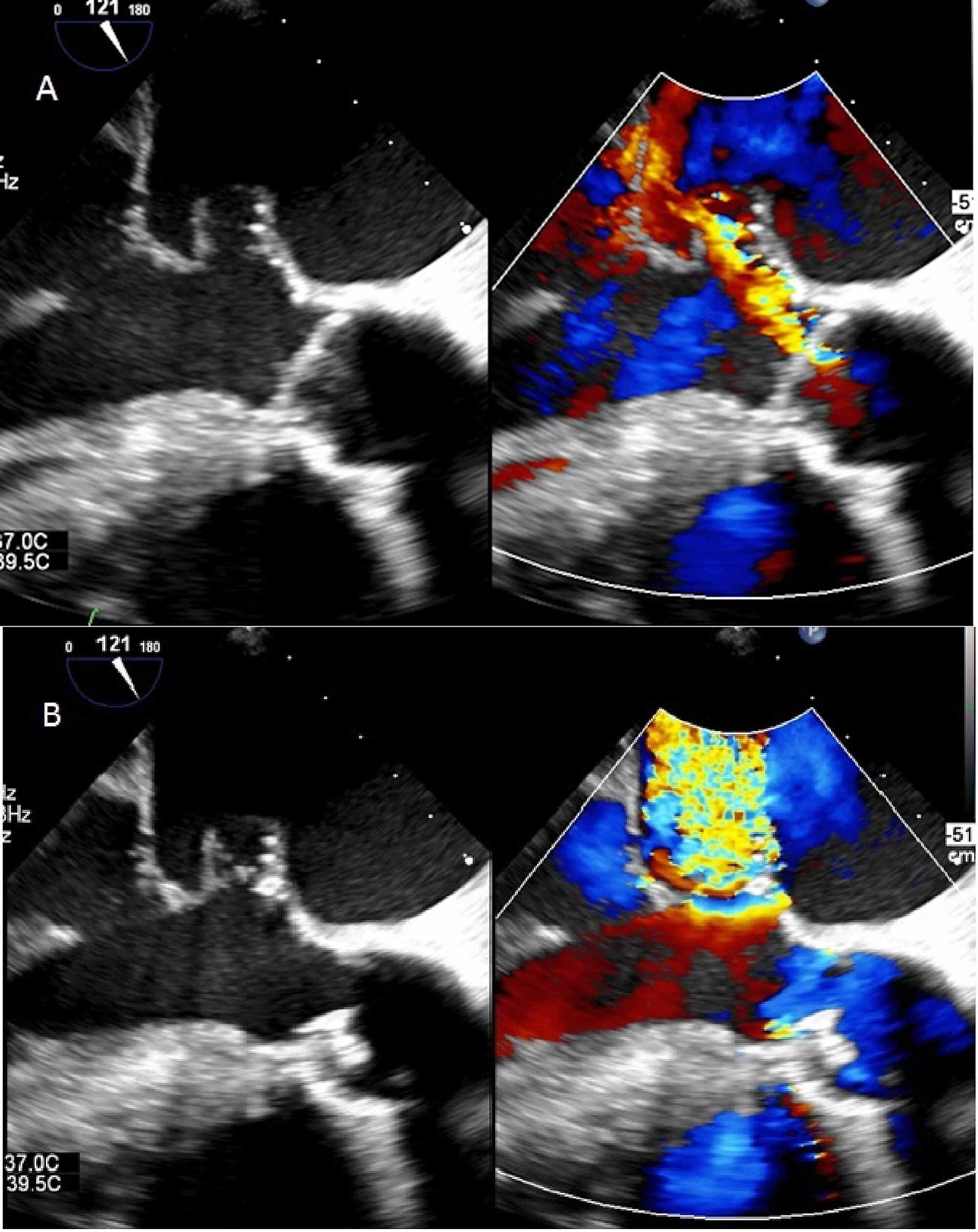 Cureus A Perforated Mitral Valve Aneurysm A Rare but Serious