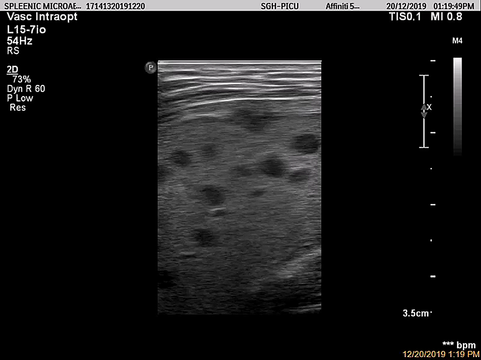 Cureus Utilization Of Point Of Care Ultrasound To Detect Splenic