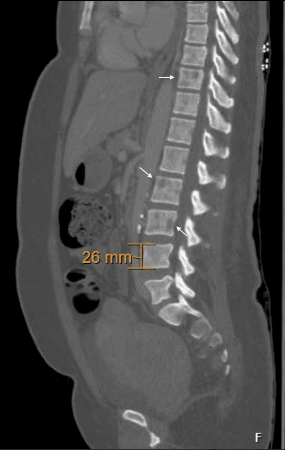 Lambda Light Chain Multiple Myeloma in a 47-Year-Old Female Patient on Long-Term Clozapine Therapy