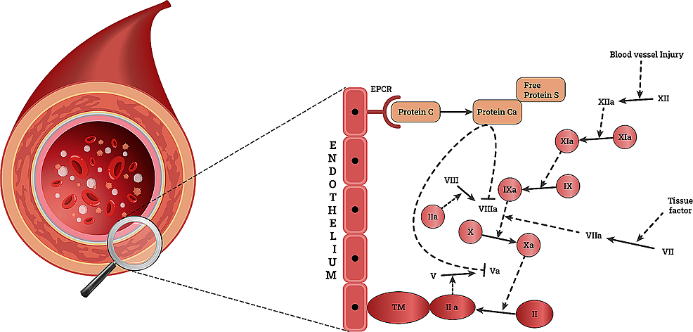 PDF) Inherited Thrombophilia and the Risk of Arterial Ischemic