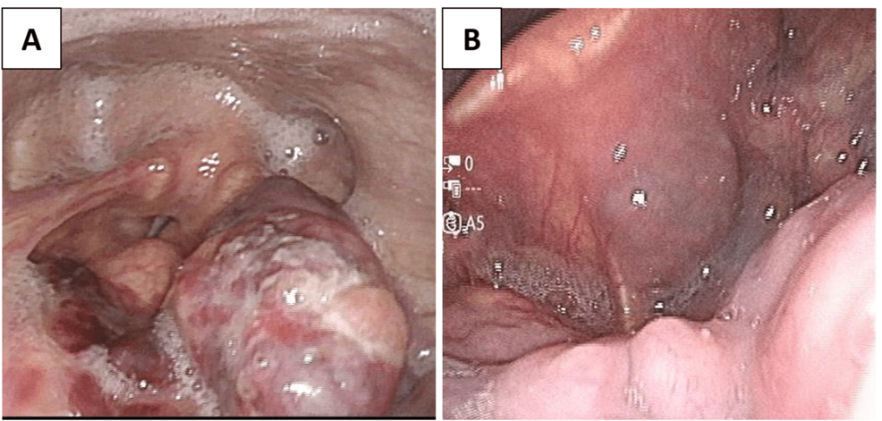 smoking cigarettes before colonoscopy reddit Cancer screening adherence among e-cigarette users in the United States Virtual Colonoscopy - NIDDK