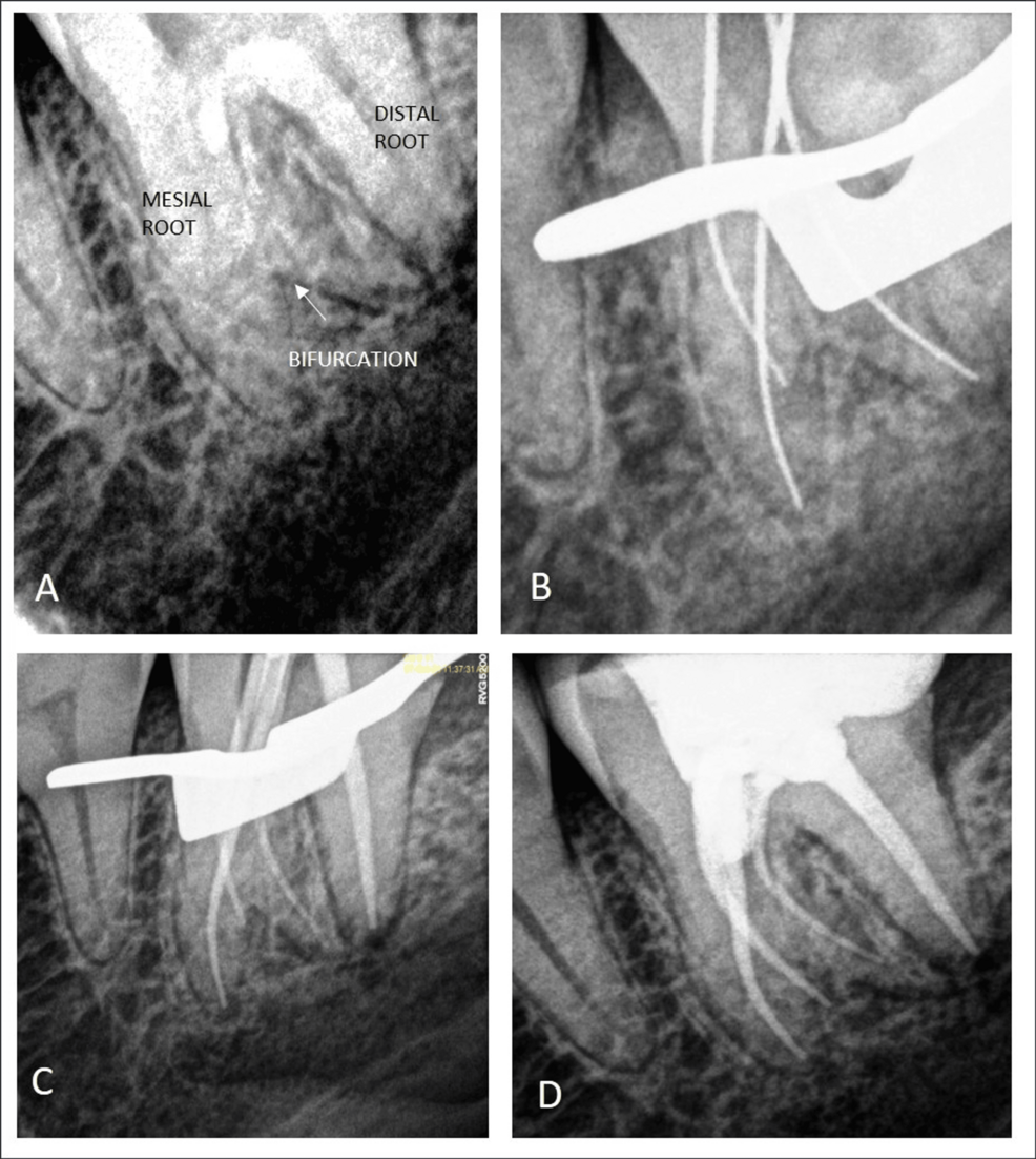 ファイル Unusual Root Canal Morphology in Mandibular Molars: A Case Series