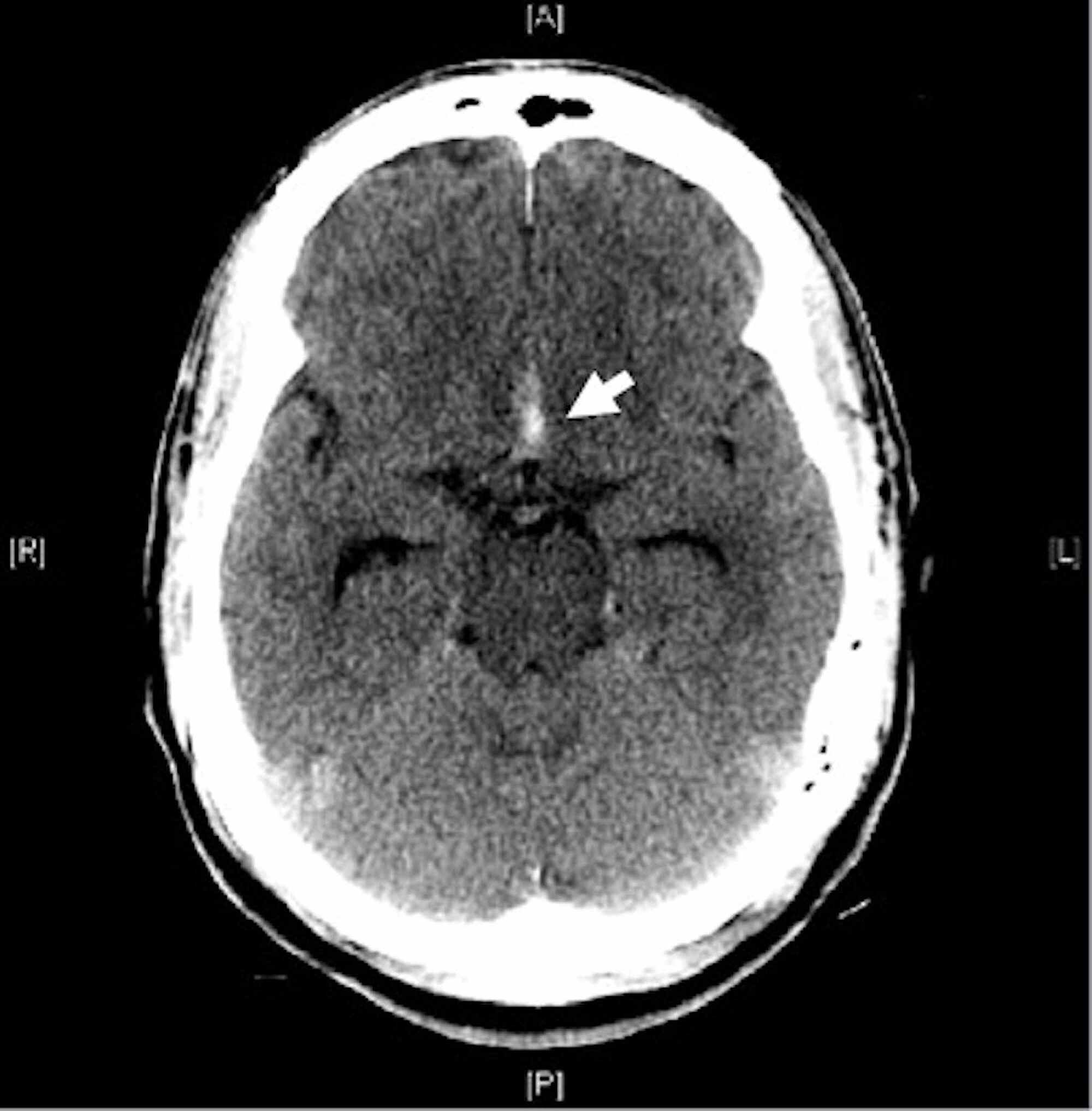 Upper Initial Head Ct Scan Showing Subarachnoid Hemor