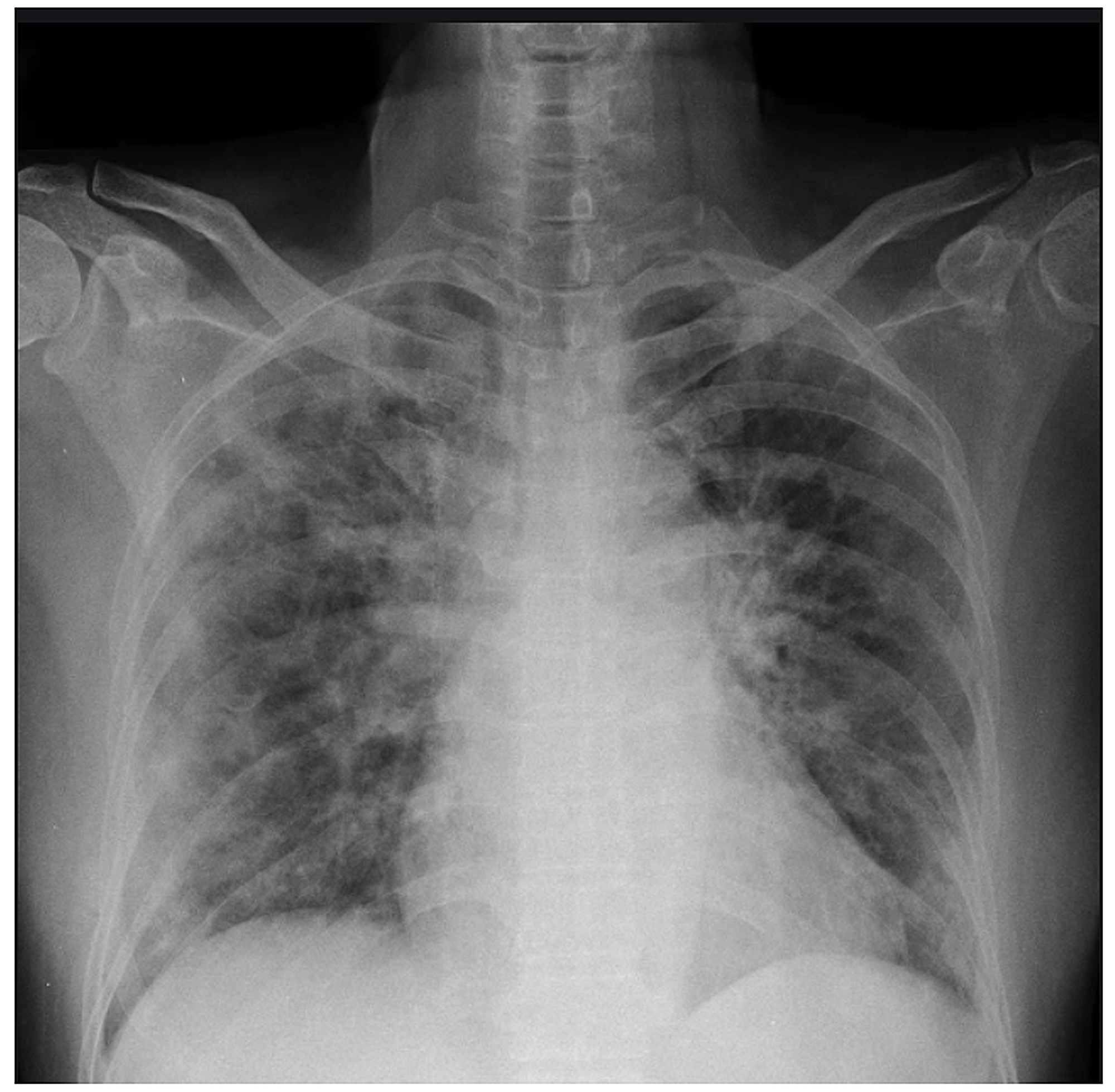 pneumonia chest x ray findings