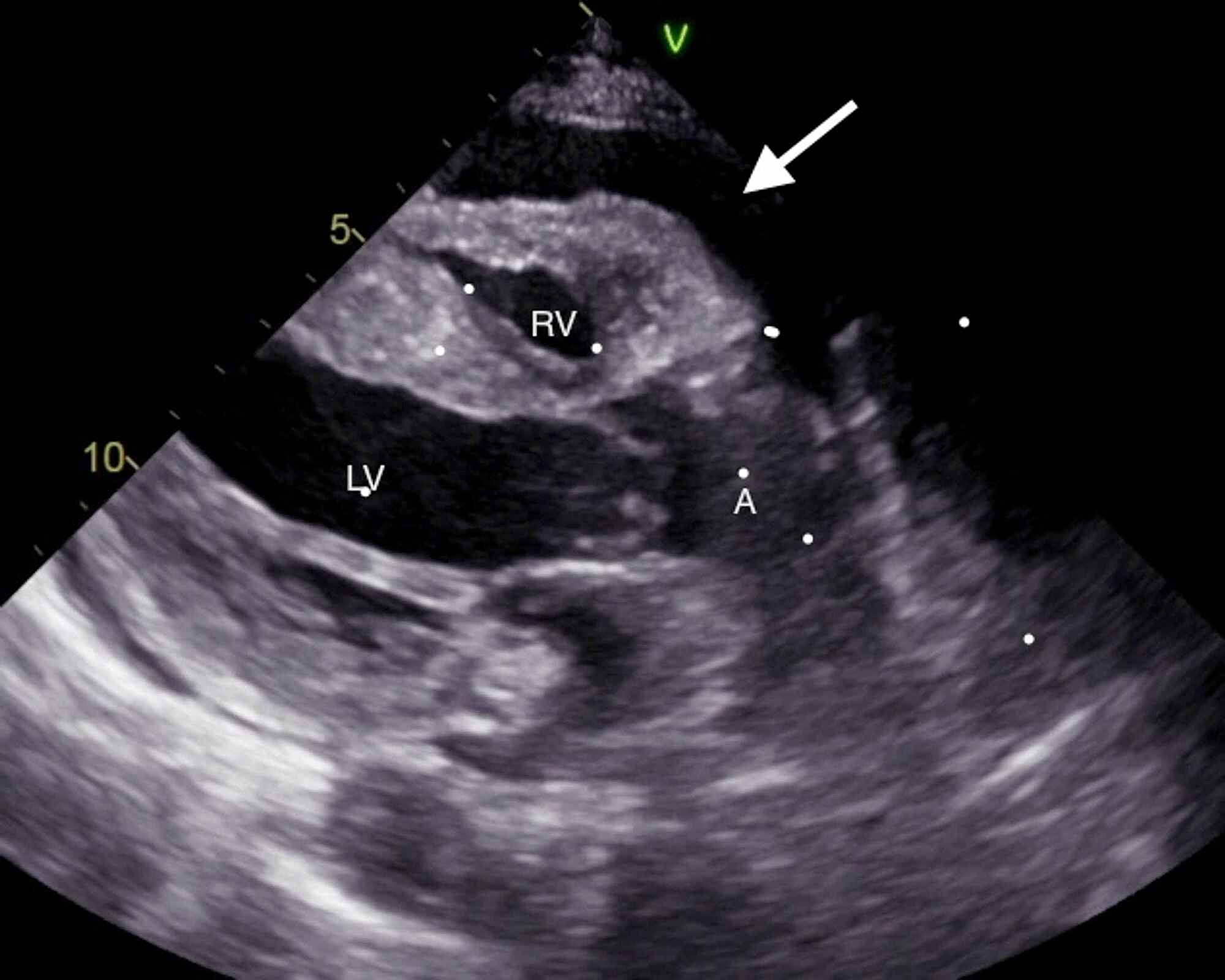 Cureus | Rare Presentation of Cardiac Tamponade in a Patient With ...