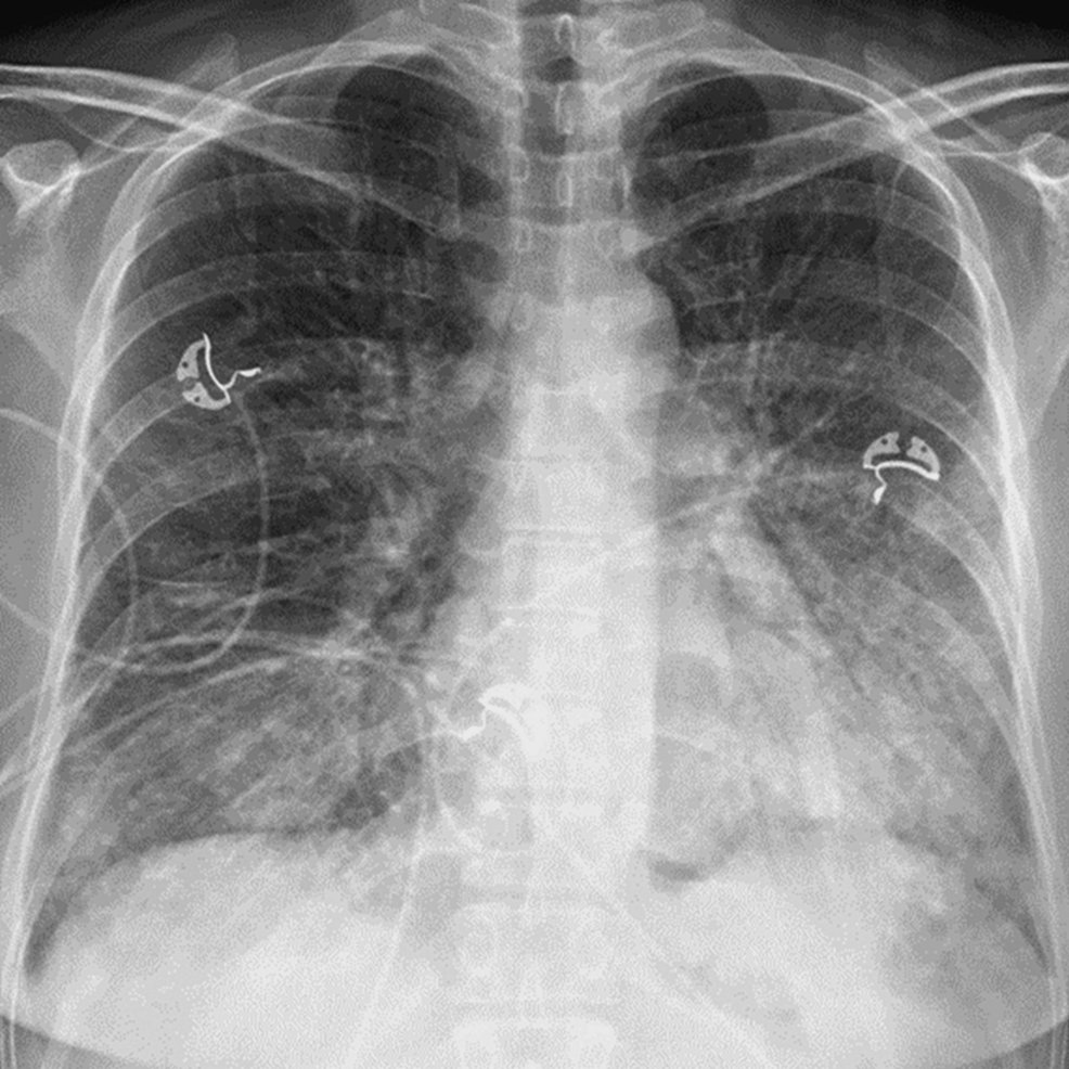 Severe Vaping Product Use‑Associated Lung Injury in a Healthy Young Adult:  A Case Report