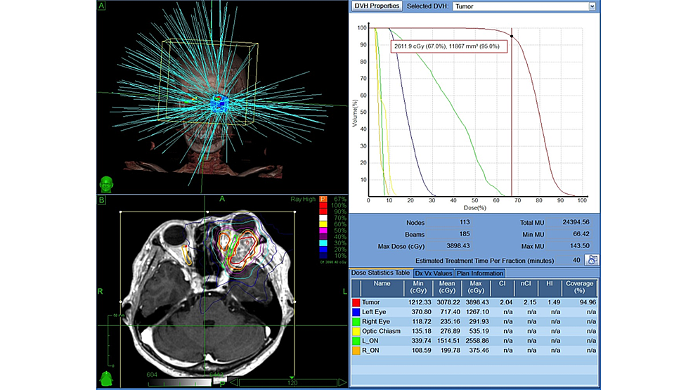 Cureus | Multisession CyberKnife Radiosurgery For Orbital Cavernous ...