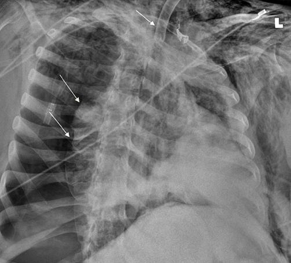Tracheostomy Exchange Resulting in Rare Combination of