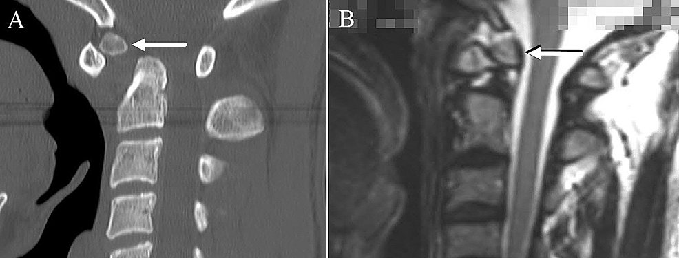 Cureus, Brainstem and Spinal Arachnoiditis Ossificans Associated With  Neurocysticercosis: A Case Report