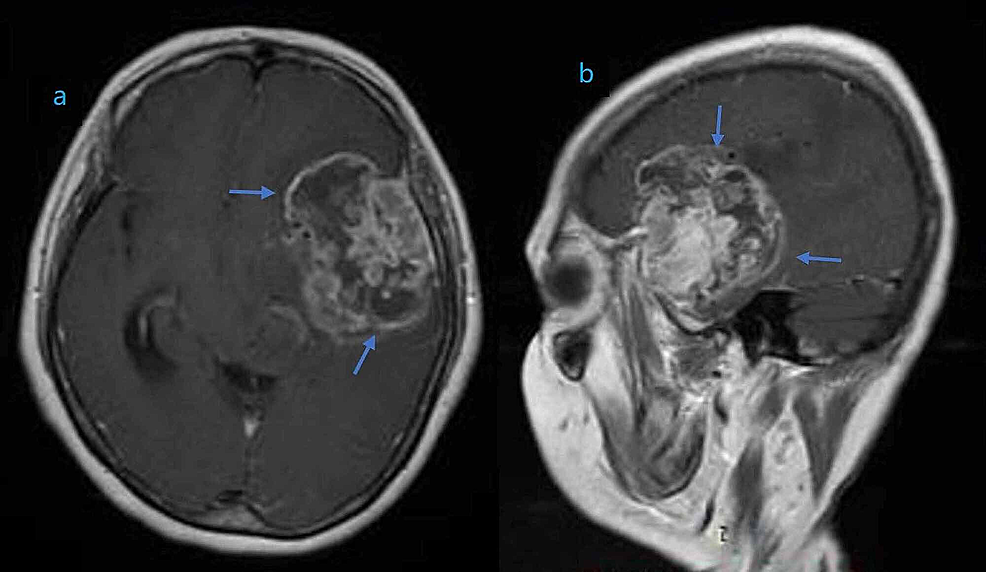 Cureus | A High-Grade Glioma of Temporal Lobe in a Child: A Case Report ...