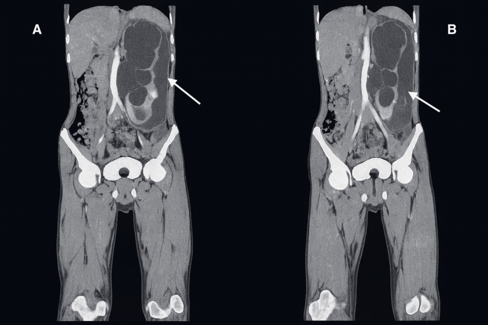 Urografía por TC, vista coronal