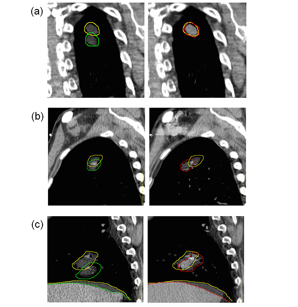 Accuracy of Breathhold CT in Treatment Planning for Lung Stereotactic