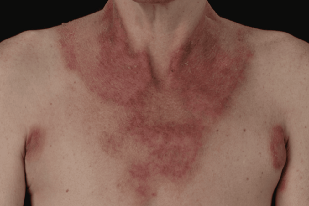 Steroid-Resistant Rash With Neuropsychiatric Deterioration and
