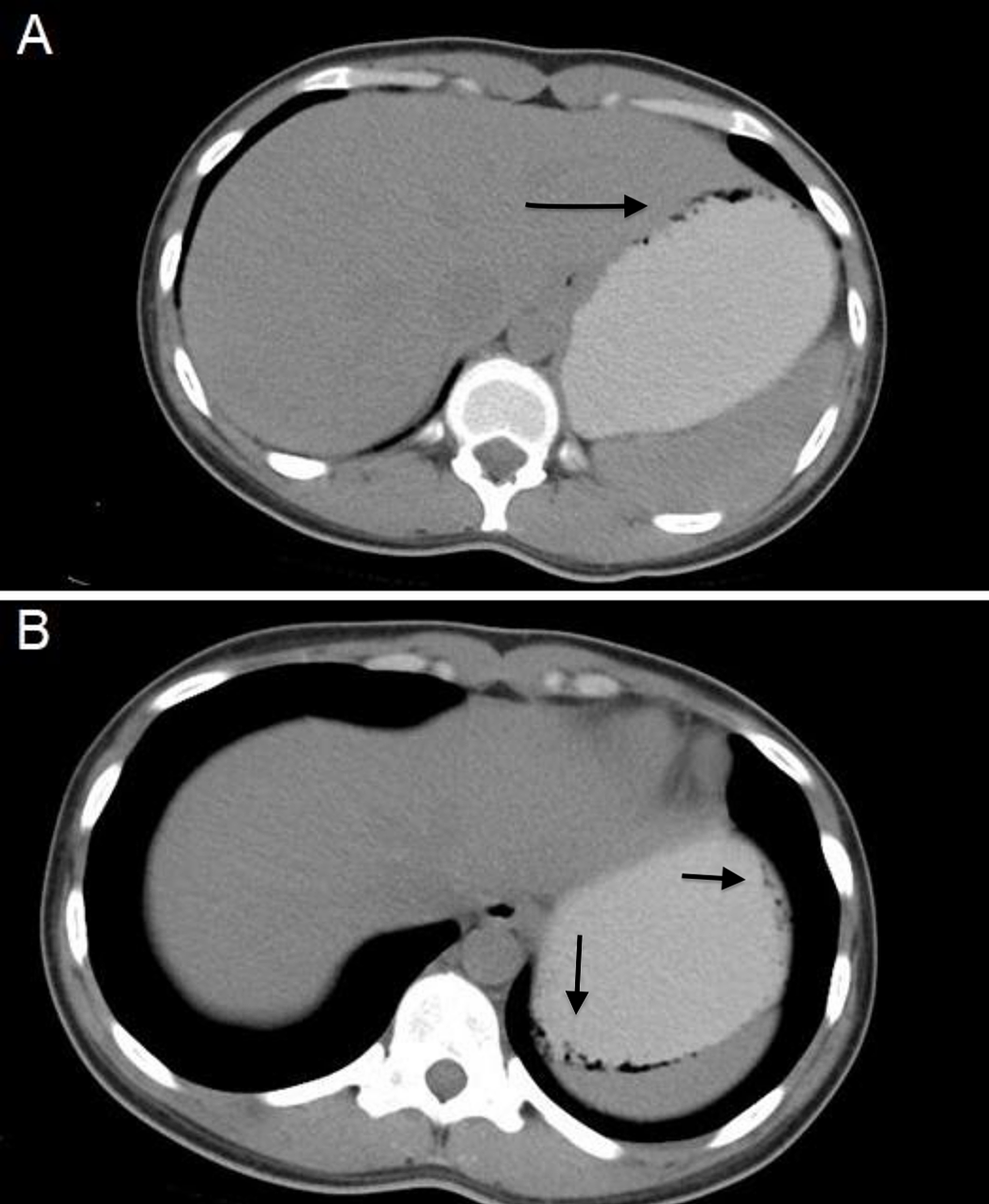 Cureus A Case Of Gastric Emphysema Incidental Findings Or Serious Illness
