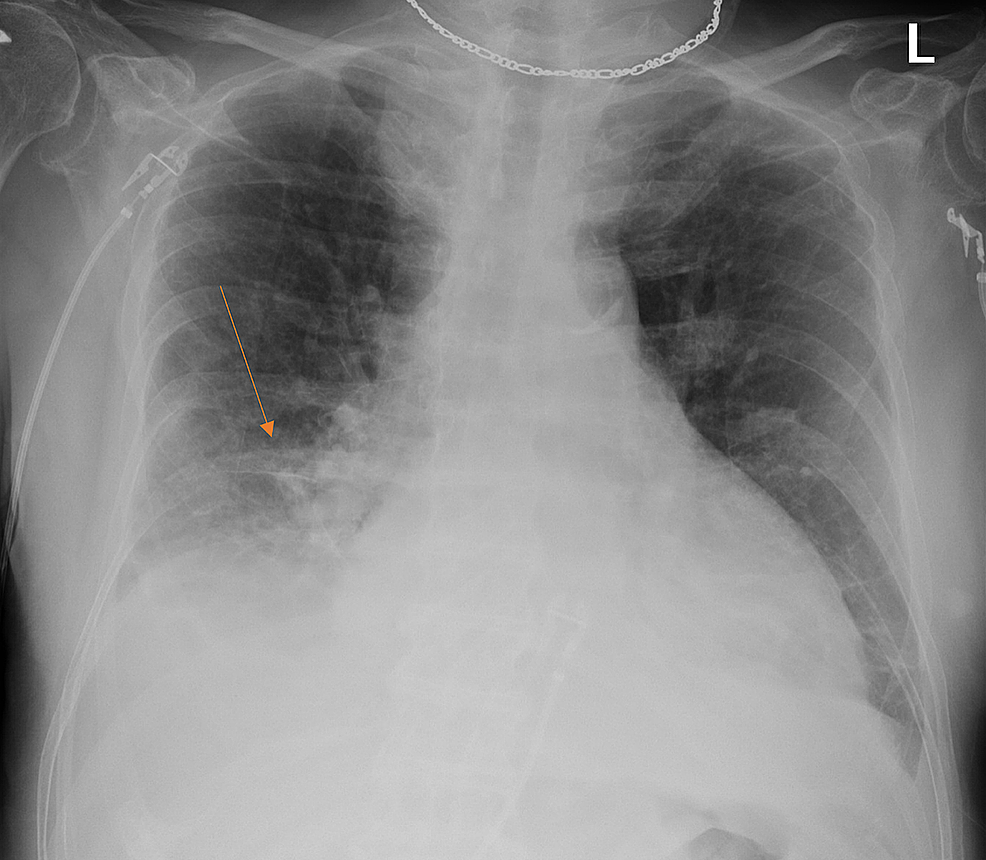 Chest X Ray Atelectasis vrogue.co