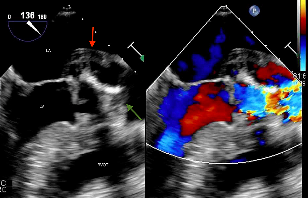 Cureus | First-Degree Heart Block: The Guiding Light to Discovering an ...