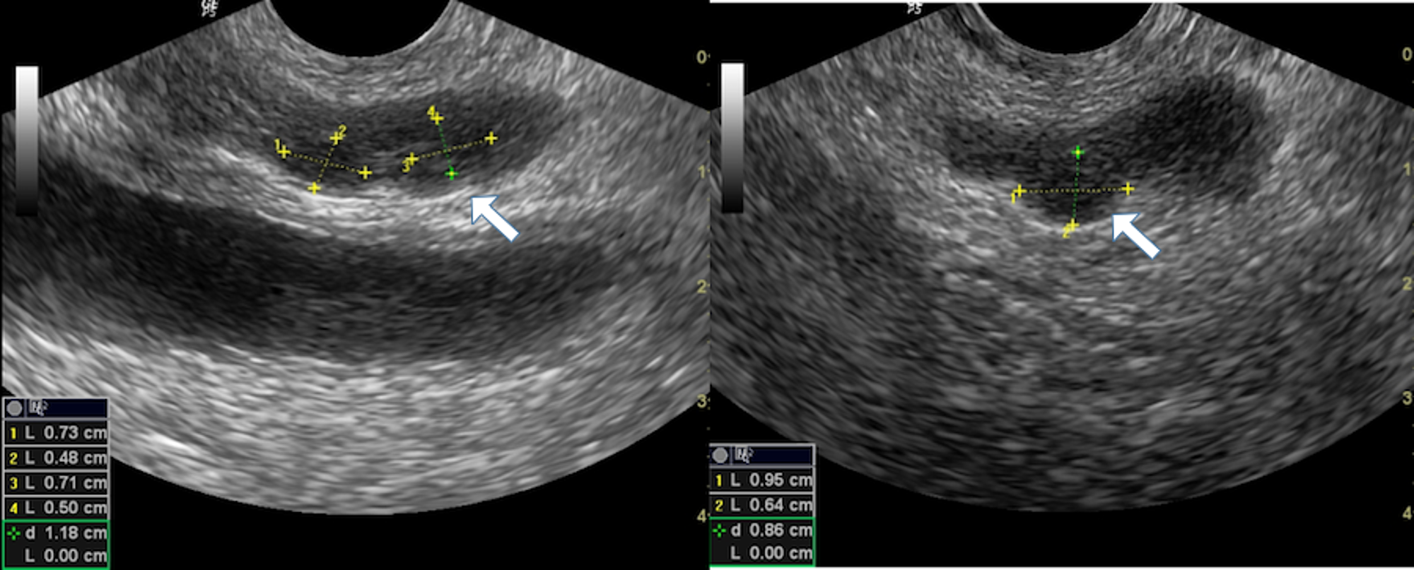 Cureus | Unique Association of Multiple Seminal Vesicle Cysts with ...