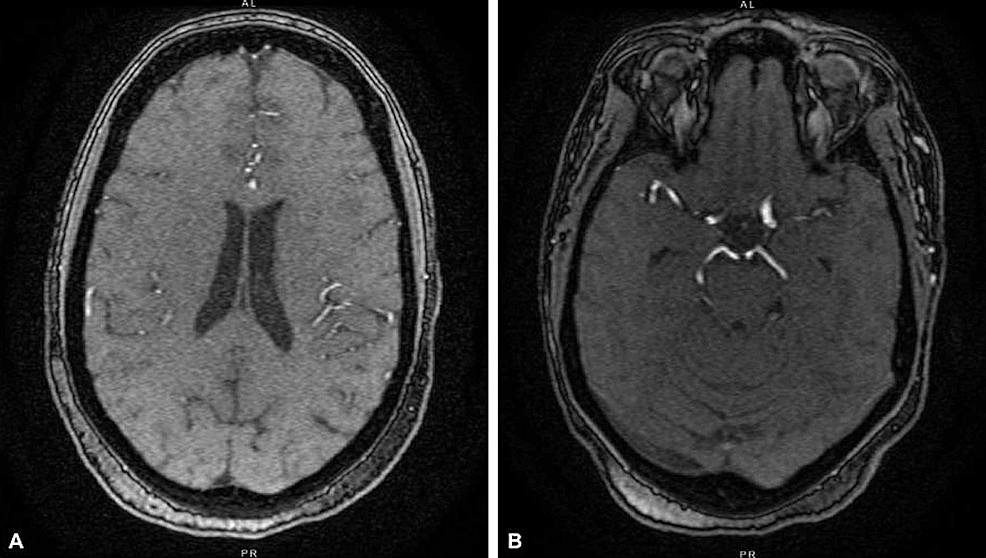 A.-T1-weighted-MRI-of-the-brain-without-contrast-at-the-patient’s-second-ED-visit;-B.-MRA-of-the-brain-without-contrast-at-the-patient’s-second-ED-visit