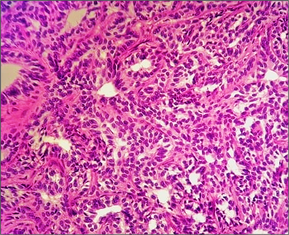 Cureus Uterine Tumor Resembling Sex Cord Tumor A Case Report