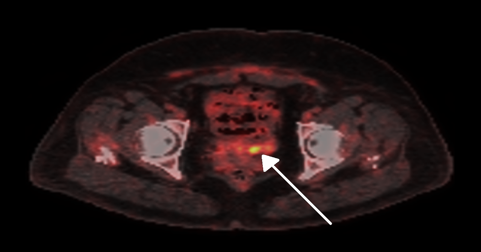 Cureus Rare Case Report Of An Endometrial Adenocarcinoma Arising In A