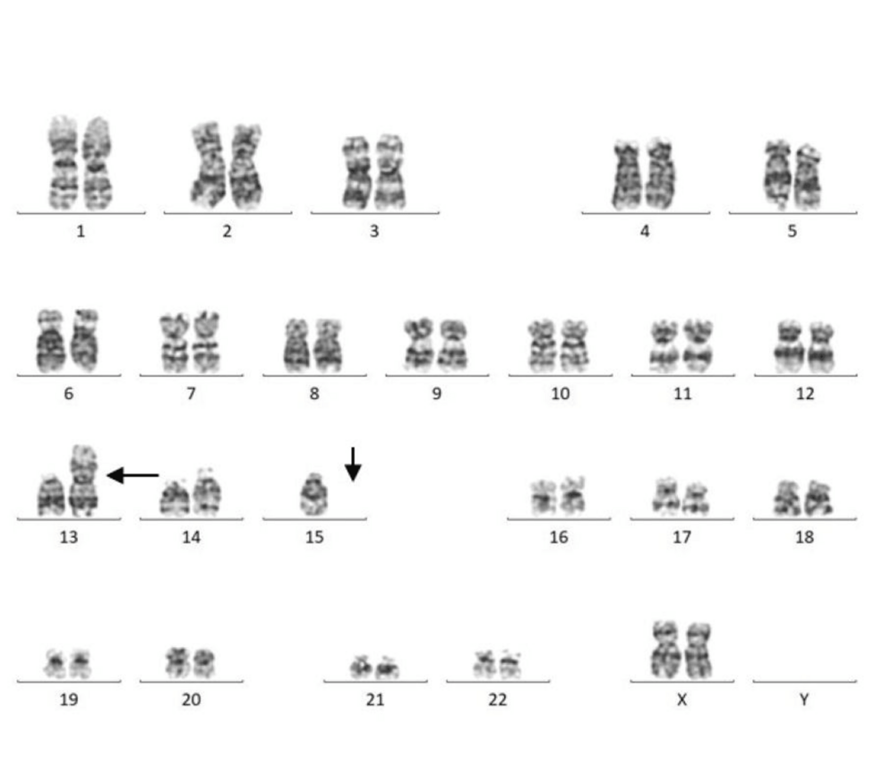 Chromosomal Abnormalities in Recurrent Pregnancy Loss at a Tertiary Care  Center | Cureus, image size:986x847